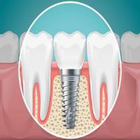 Bergens Periodontics & Implant Dentistry Daytona image 5